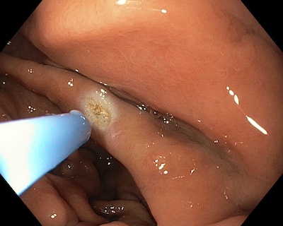 100H0009 gastric angioectasia and apc